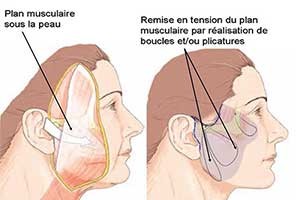 lifting cervicofacial tunisie