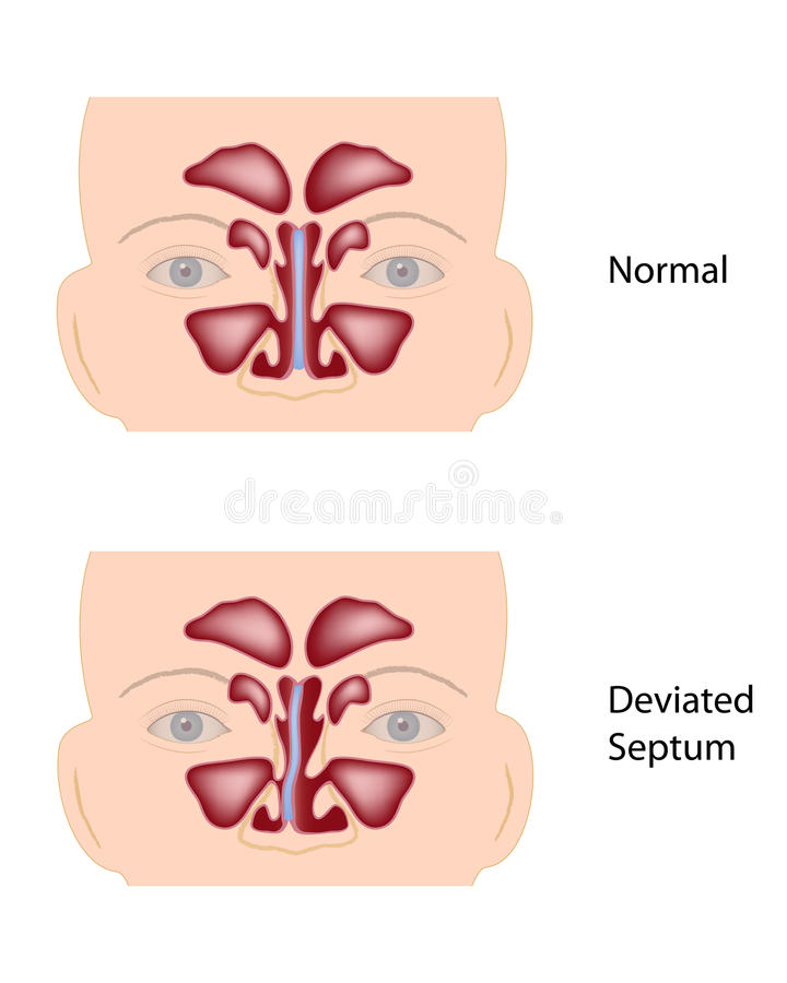 septum dévié