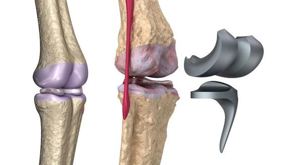 chirurgie-orthopedique-tunisie